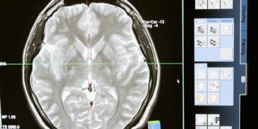 epostalar-sizdi-gizemli-beyin-hastaliginin-arastirilmasi-engellendi-DrHUGEga.jpg