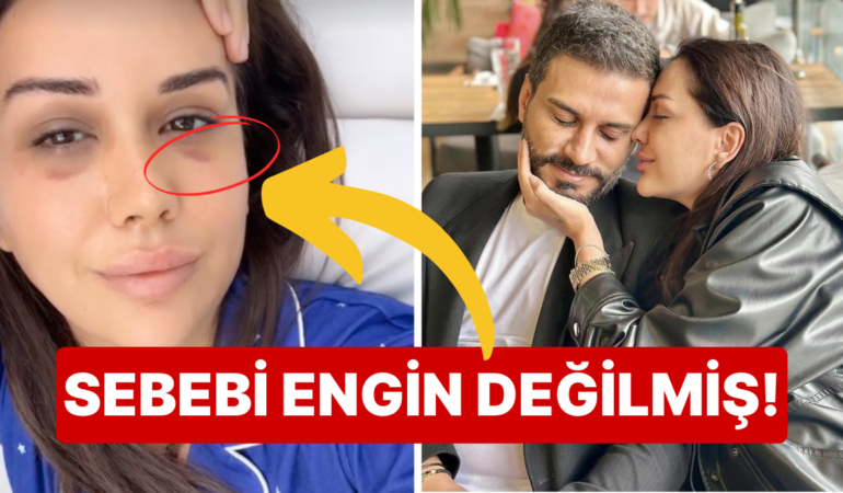 Ablasına Taşınıp Evde Bile Gözlük Takan Dilan Polat’ın Yüzündeki Morlukların Nedeni Nihayet Belli Oldu!