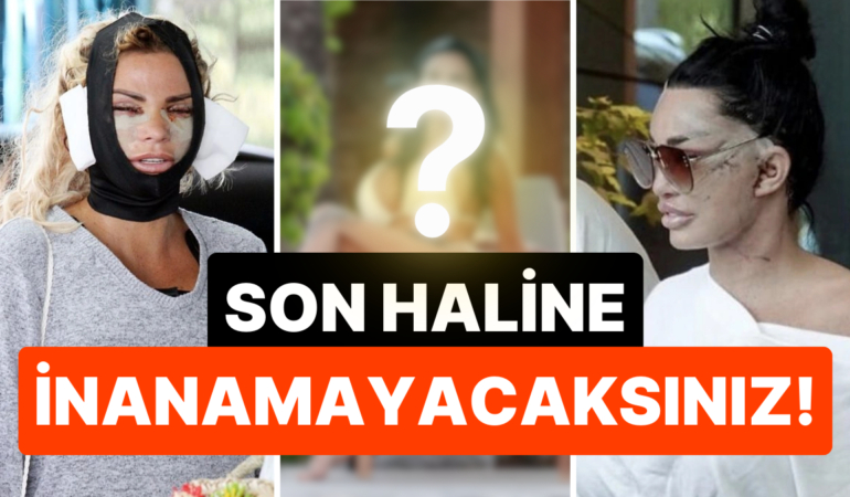 Kendisini Türk Hekimlerine Emanet Edip Sayısız Estetik Operasyonu Geçiren Katie Price’ın Son Hali Şoke Etti