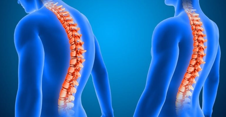 Yüzde 80’i ergenlikte ortaya çıkan skolyozun erken tanısı için ailelere uyarı