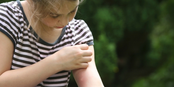 Havaların ısınmasıyla ortaya çıkan sinek ısırıklarına karşı doğal çözümler nelerdir?